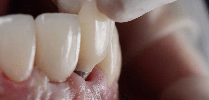 How Does A Dentist Fix A Failed Implant?