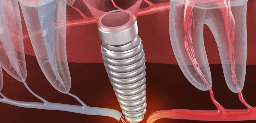 Why do dental implants break