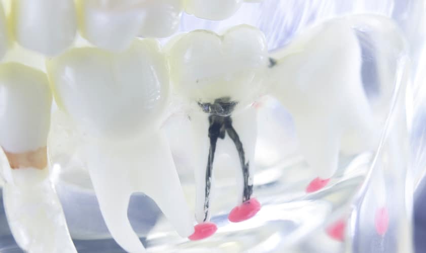 root canal procedures for various tooth types