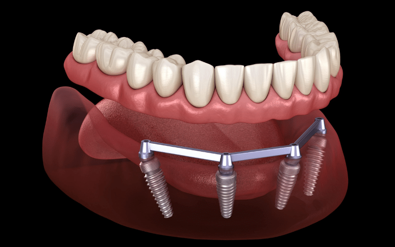 Does Food Get Stuck Under All-On-4 Dental Implants