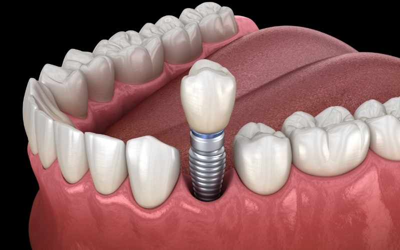 What Are the Advantages of Dental Implants Over a Dental Bridge