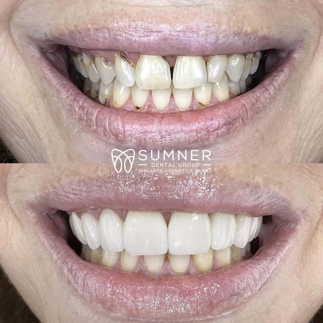 before after result of dental treatment