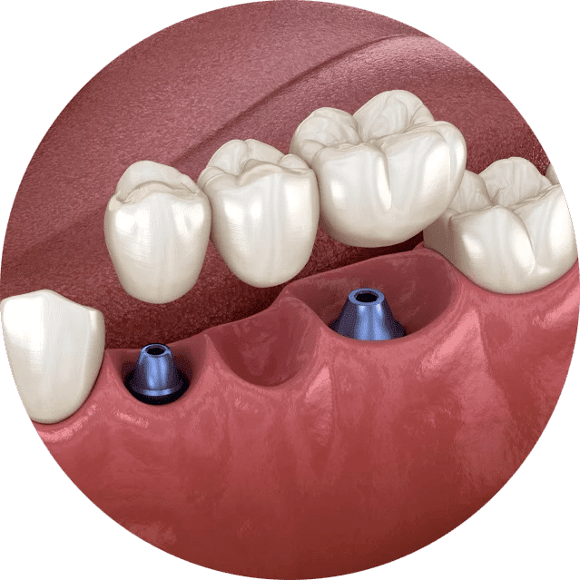implant supported bridge