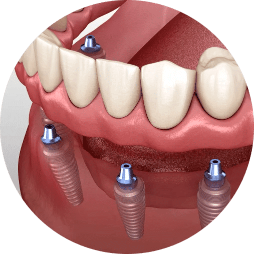 implant supported overdenture