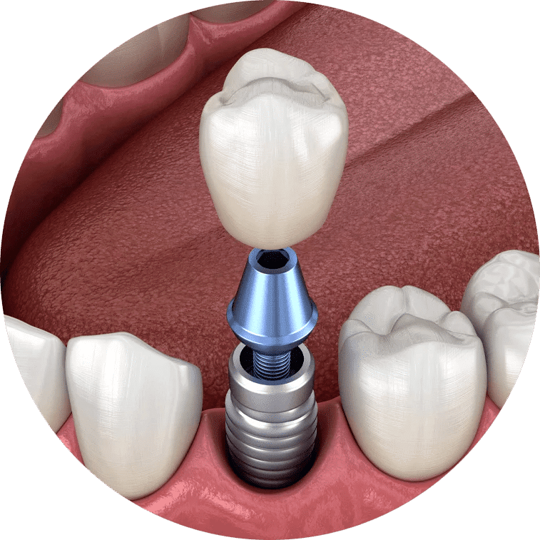 single tooth dental implant