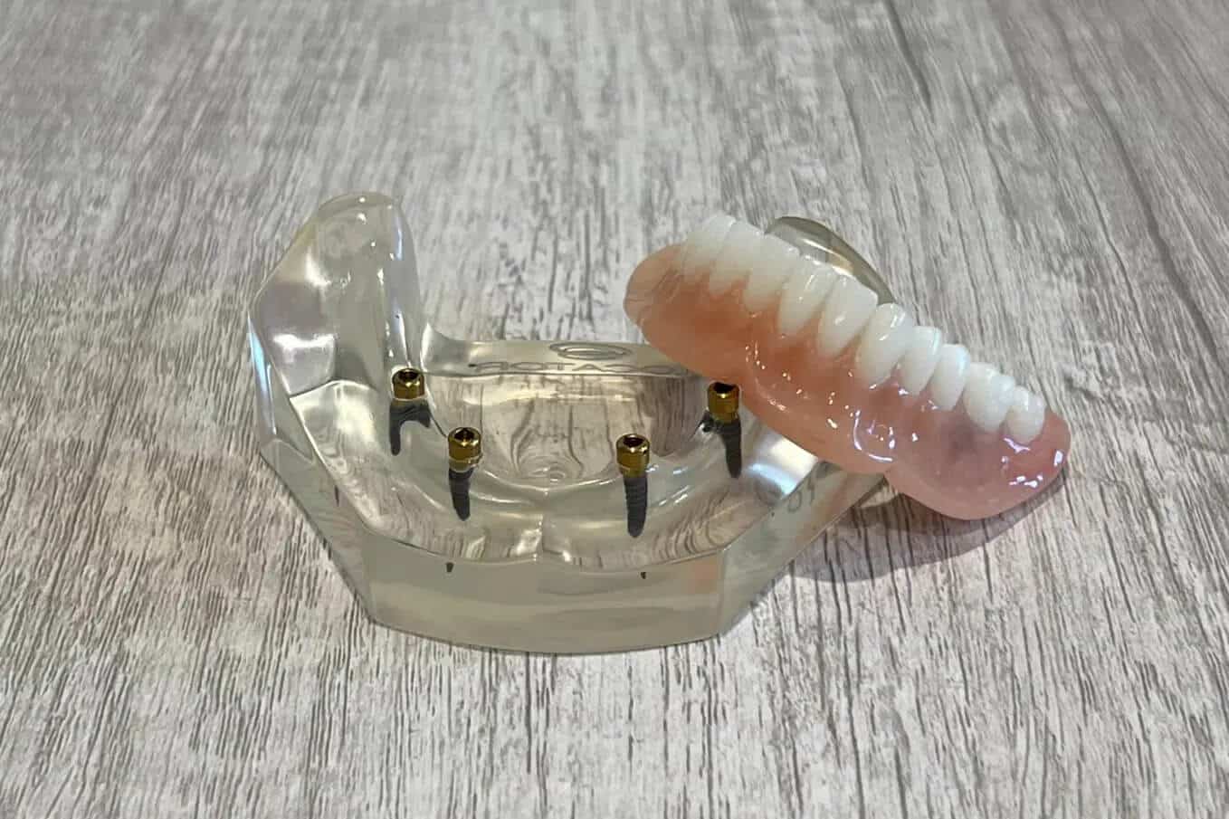snap in implant denture unsnapped