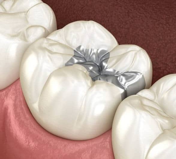 what are dental sealants