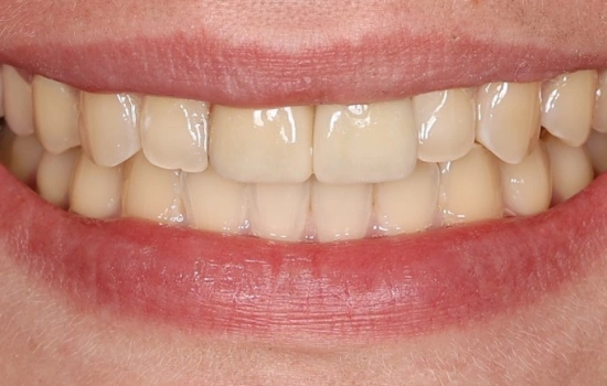 After cosmetic dental treatment showing the patient's restored, natural-looking smile.