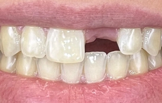 Before treatment showing the patient's smile prior to treatment.
