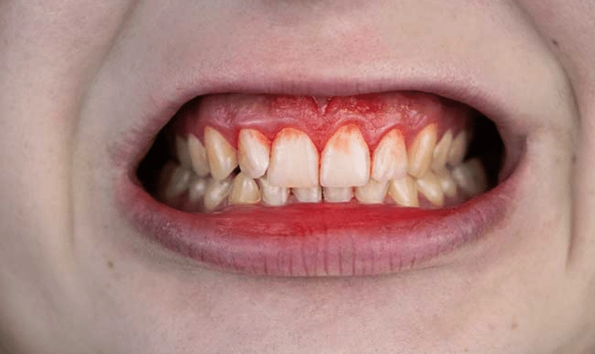 All The Antibiotics Used In Gum Disease!