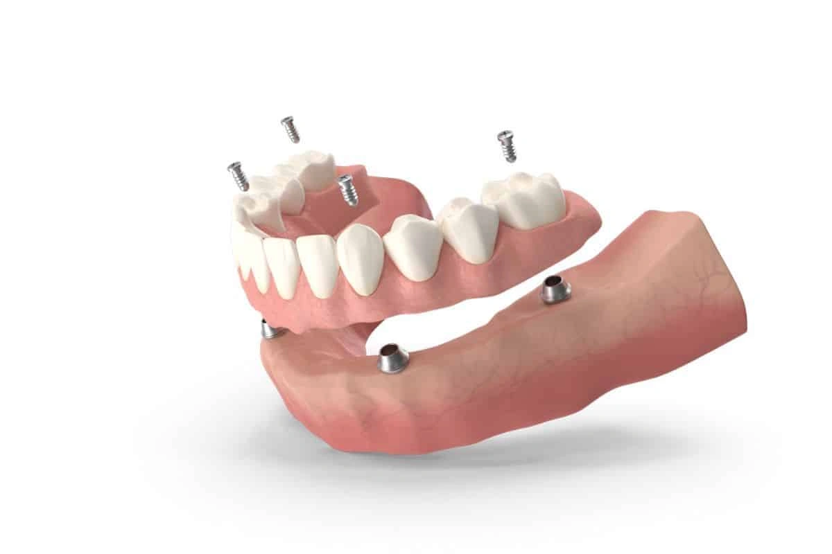 Are You a Candidate for All-On-4 Implants? Key Eligibility Factors