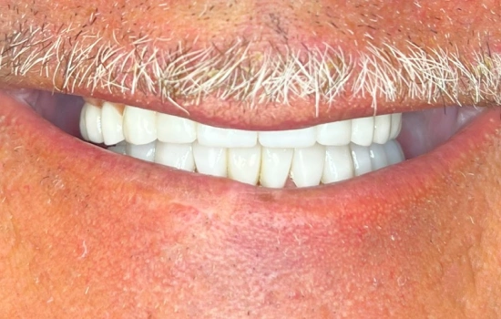 After cosmetic dental treatment with a brighter, fuller smile.