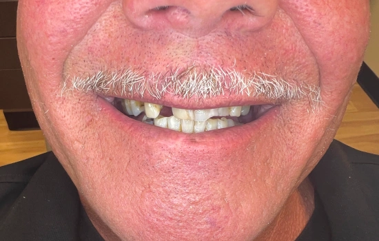 Before cosmetic dental treatment showing worn upper teeth.