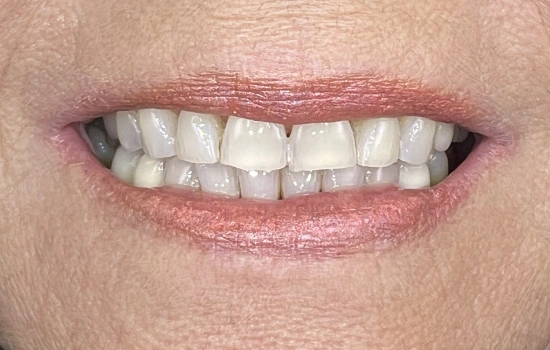 After smile makeover with whiter, straighter-looking teeth.