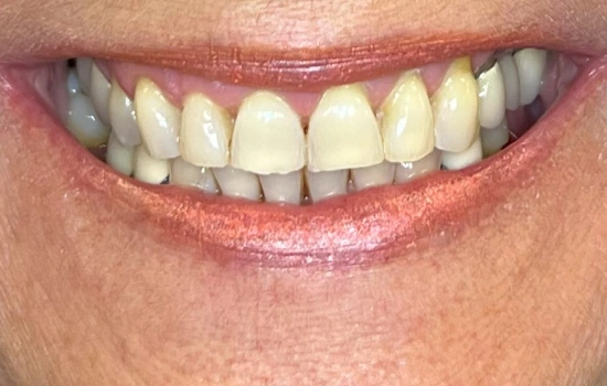 Before smile makeover with stained and crowded teeth.