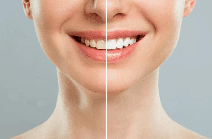 Can Dental Sealants Be Removed?