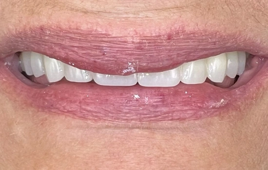 After cosmetic reconstruction restoring a complete, confident smile.