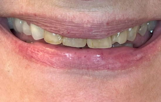 Before cosmetic reconstruction with multiple missing front teeth.