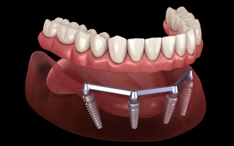 Does Food Get Stuck Under All-On-4 Dental Implants?