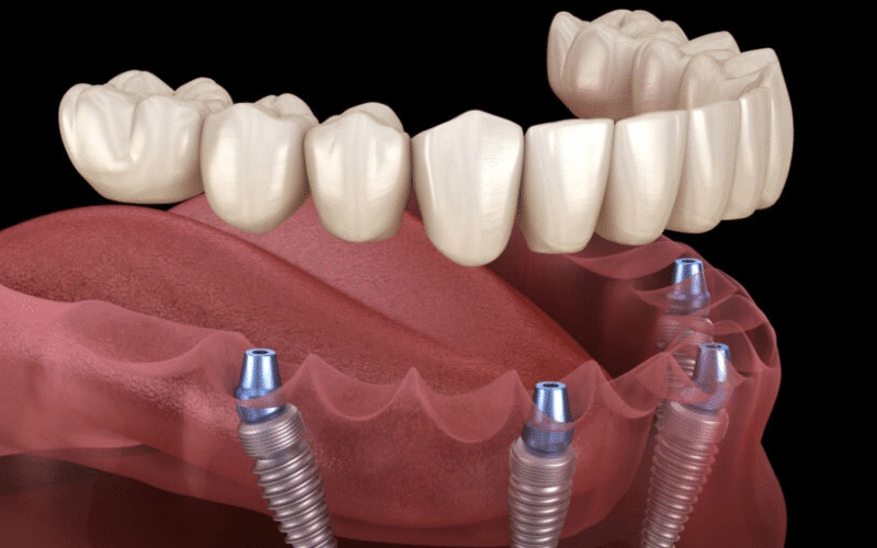Full Mouth Implants And Your Diet: How To Enjoy Your Favorite Foods Again