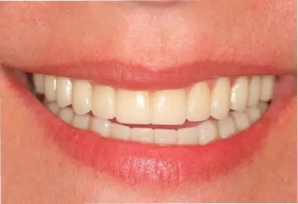 Patient smile restored after treatment at Sumner Dental group