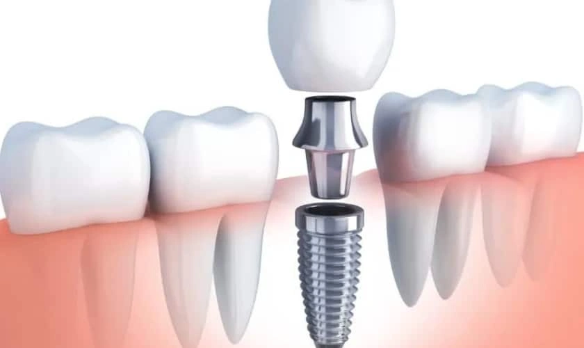 How To Care For Your Dental Implants: Tips And Tricks