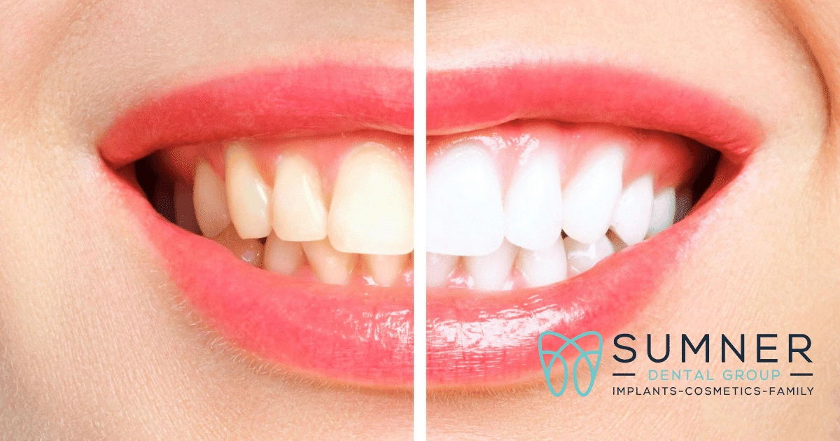 How to make your smile whiter?