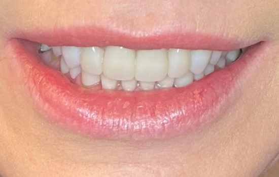 After cosmetic dentistry creating a brighter, symmetrical smile.
