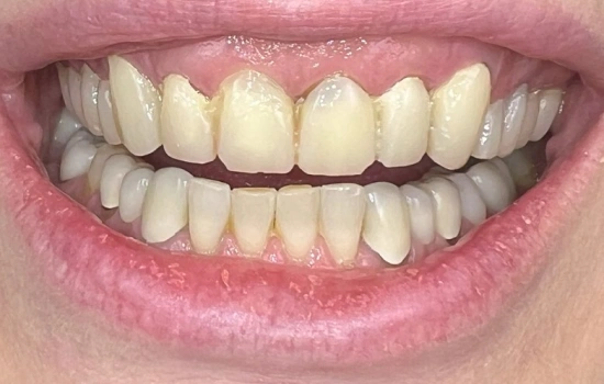 Before cosmetic dentistry with stained and uneven teeth.