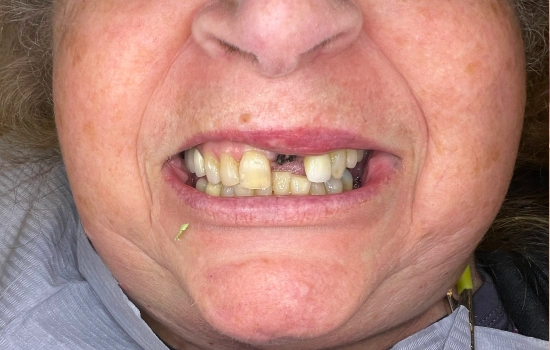 Before smile reconstruction with damaged and discolored front teeth.