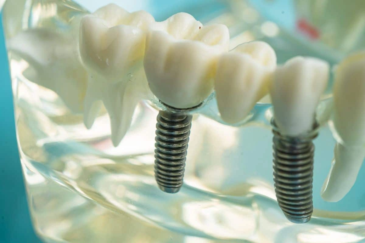 Recovery Tips After All-On-4 Teeth in a Day Surgery