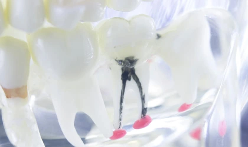 Root Canal Procedures for Various Tooth Types