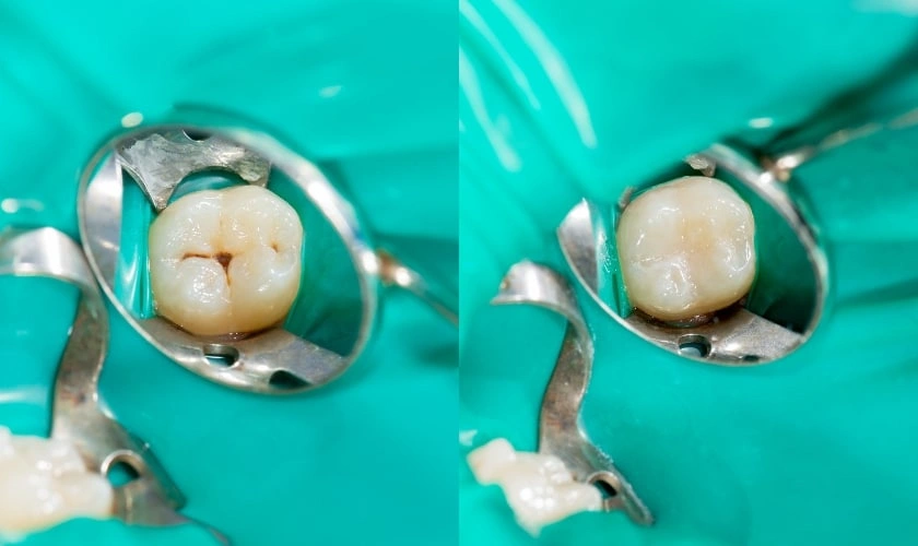 The Benefits of Replacing Your Composite Fillings