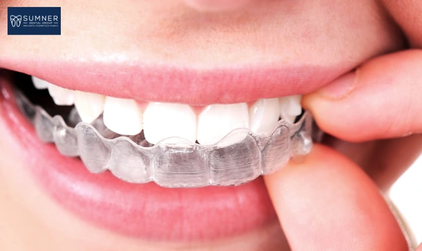 The Impact of Invisalign: A New Trend of Almost Invisible Braces