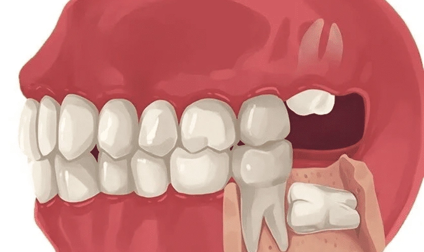 The Importance of Wisdom Teeth Removal for Oral Health