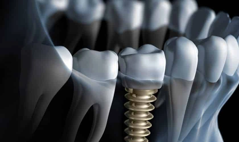 The Smile Upgrade: Unleashing Radiance and Happiness with Dental Implants