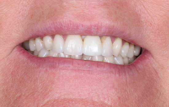 After cosmetic dental treatment showing the patient's restored, brighter smile.
