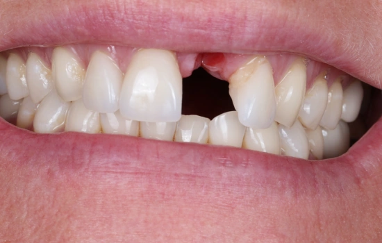 Before dental treatment showing the patient's smile prior to treatment.