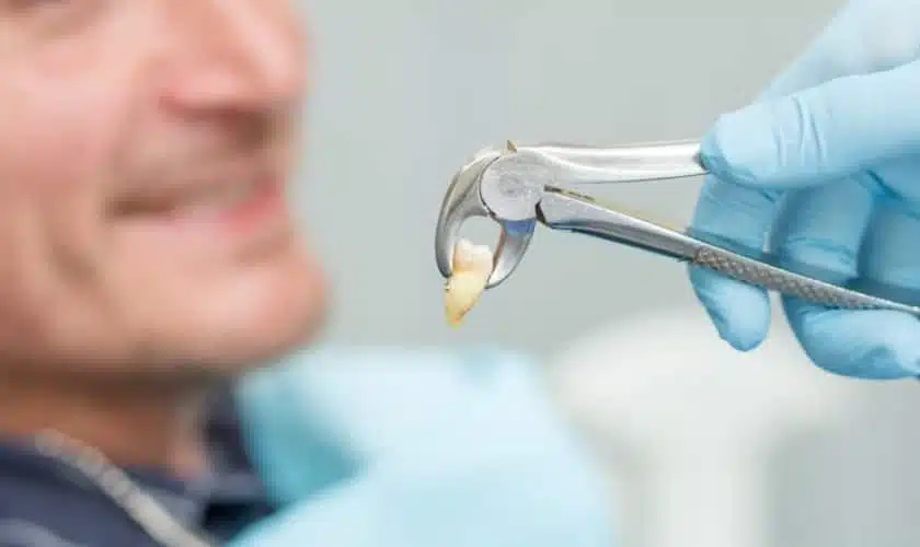 Understanding Tooth Extraction