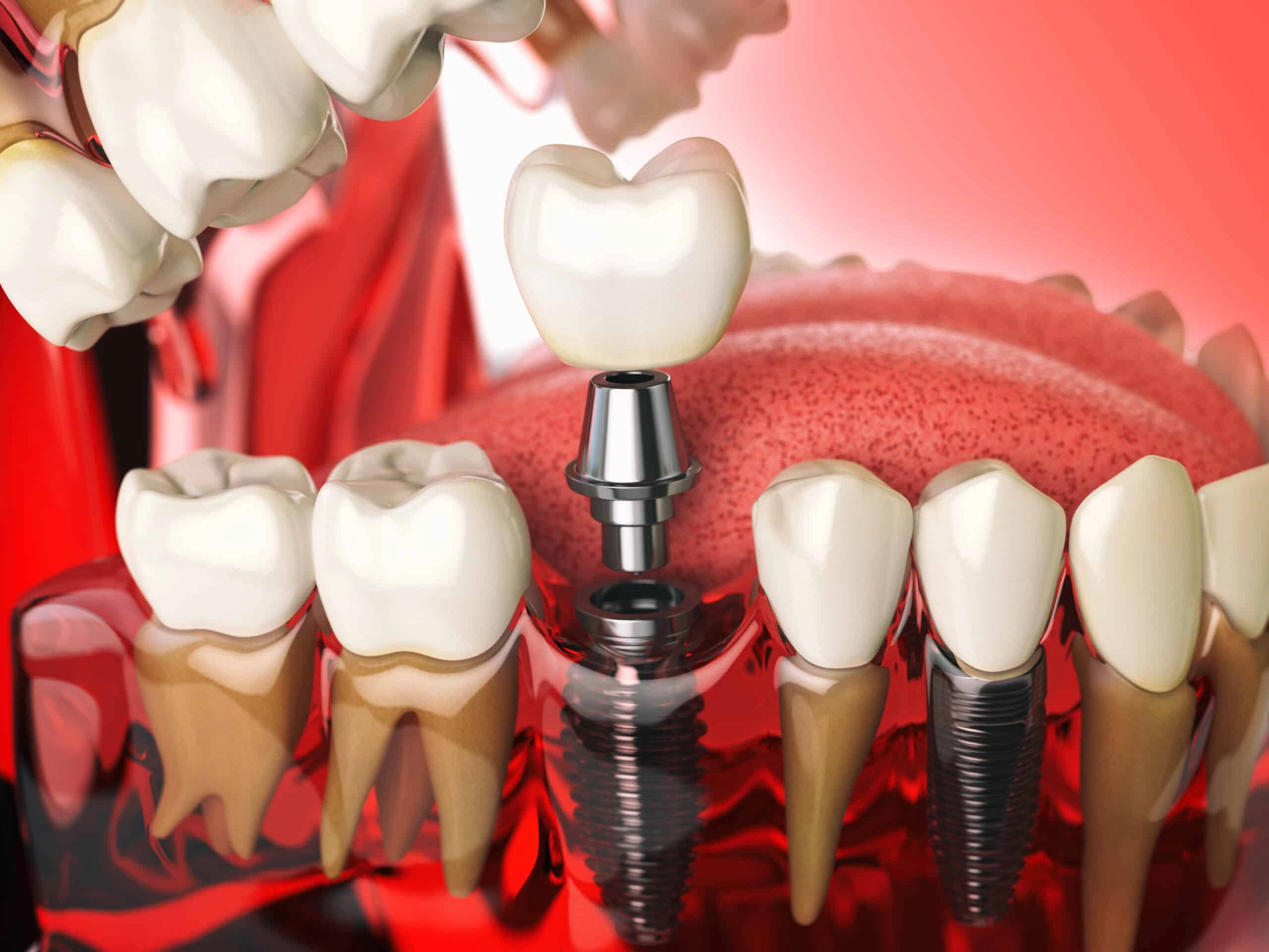 What Should You Know About Dental Implants?