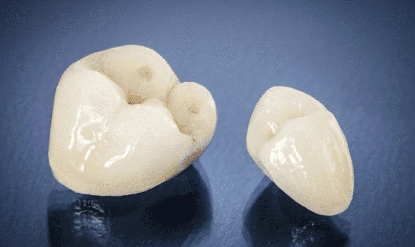 What To Do If Dental Crown Breaks?