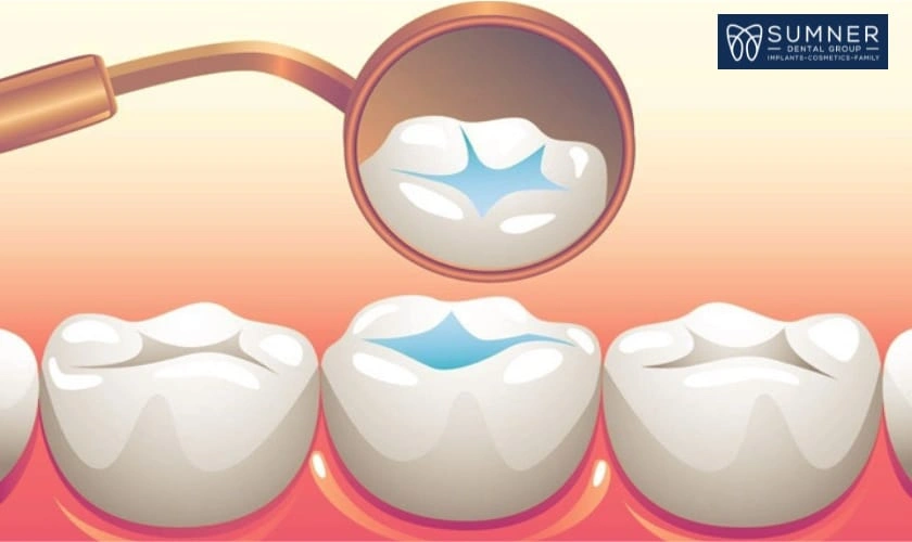 What is the Dental Sealants Procedure?