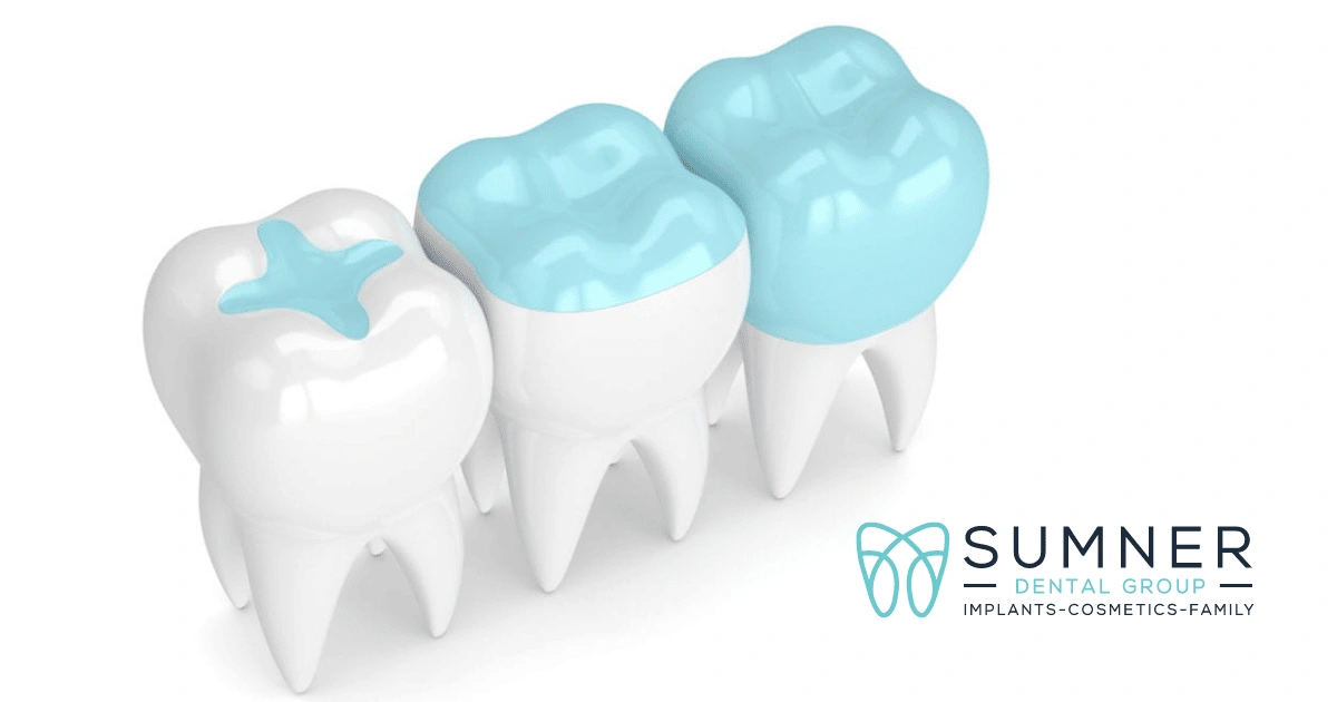 What is the Difference Between a Dental Sealant and Filling?