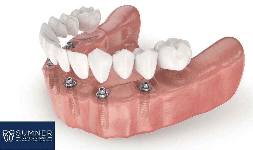 Why Are Dental Implants So Popular