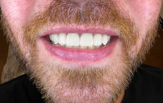 After cosmetic dental treatment showing the patient's restored, confident smile.