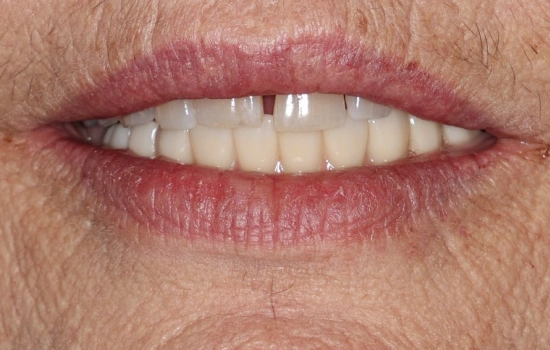 After dental treatment showing the patient's restored smile.