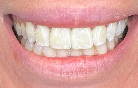 After cosmetic dentistry with a healthy, natural-looking smile.