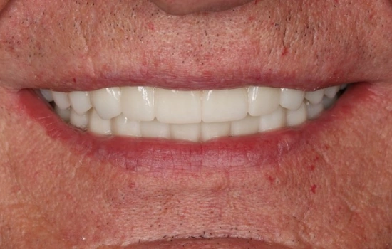 After cosmetic dental treatment showing a restored, natural-looking smile.