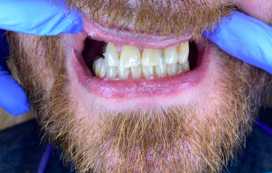 Before cosmetic dental treatment showing the patient's smile prior to treatment.