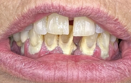 Before dental treatment showing the patient's smile prior to treatment.